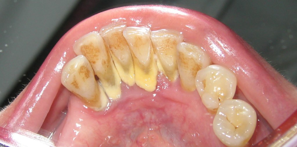 Tooth Plague