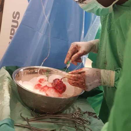 Aminu Kano Teaching Hospital Performs 47Th Successful Kidney Transplant