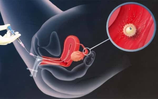 Artificial Insemination: Make Sure You Are Carrying Your Child