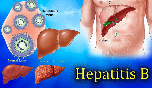 Hepatitis B: 2 Basic Things You Can’T Ignore Hapatitis B 2 Basic Things To Know