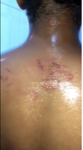 #Endsars Protester, Treasure Shares Gory Body Injuries From Police Brutality