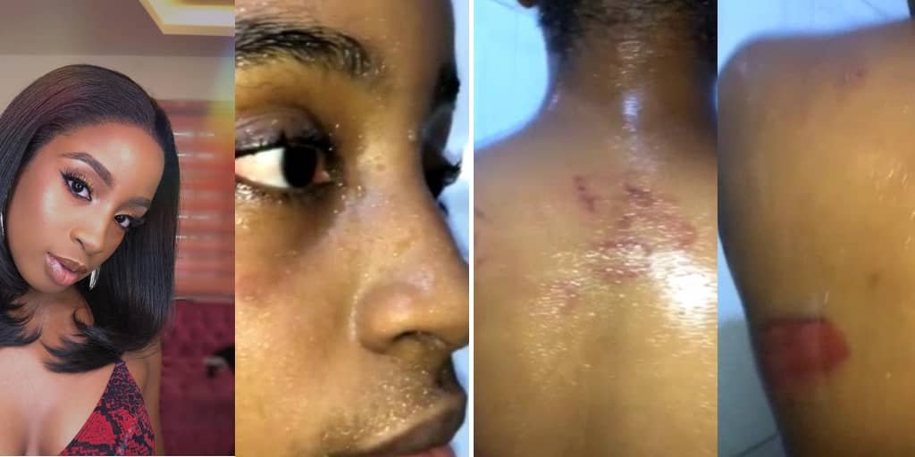 Lady Shares Bruises, Narrates Experience With Sars