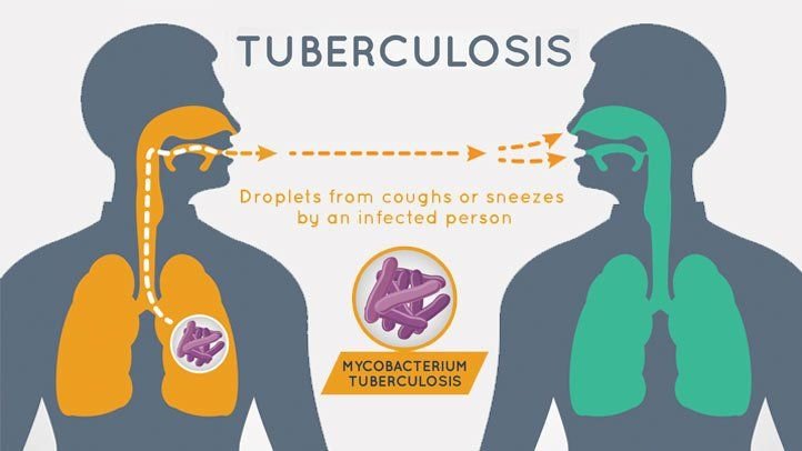 Tuberculosis